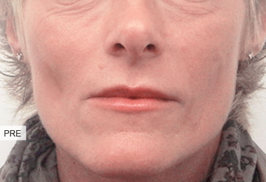 REGENYAL IDEA Bio-Expander