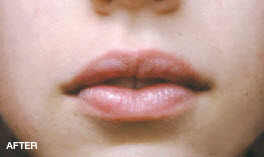 REGENYAL IDEA Lips